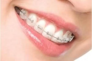Làm sao để niềng răng không nhổ răng? 