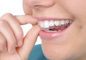 Nên chọn niềng răng bằng sứ hay niềng răng invisalign