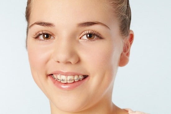 Niềng răng thông thường không thể thẩm mỹ bằng niềng răng Invisalign.