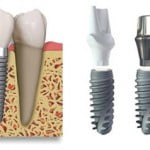 Implant nha khoa là giải pháp cấy ghép răng hiện đại