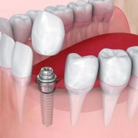 Hàm răng có cấy ghép implant niềng răng được không?