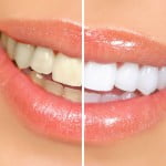 Tẩy trắng răng có lợi và có hại gì?