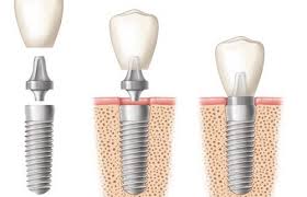 Trồng răng implant có nguy hiểm không ?