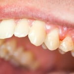 Cách khắc phục răng nanh có kích thước dài