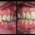 Nên niềng răng hay bọc sứ khi răng cửa mọc lệch?