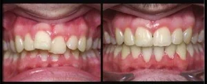 Nên niềng răng hay bọc sứ khi răng cửa mọc lệch? 