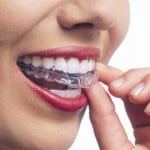 Niềng răng lệch lạc bằng khay invisalign có hiệu quả không?