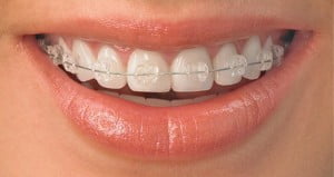 Niềng răng mắc cài sứ vừa có ưu điểm là tính thẩm mỹ cao