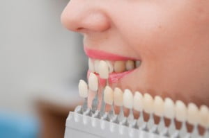 Tẩy trắng răng có làm mòn men răng không? 