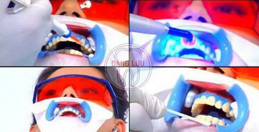 Phương pháp tẩy trắng răng hiện đại