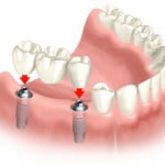 Trồng răng hoàn hảo với implant nha khoa