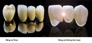 Răng sứ titan và răng sứ không kim loại
