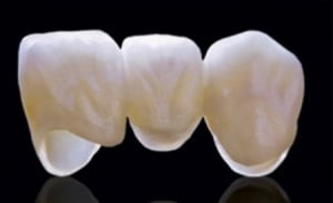 Loại răng sứ nào được bảo hành lâu nhất?