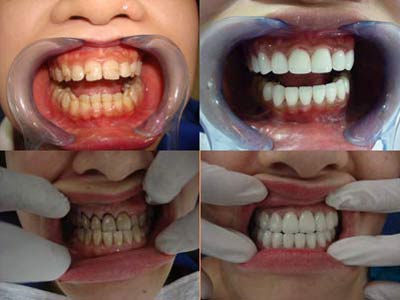 Quy trình bọc răng sứ thẩm mỹ như thế nào?