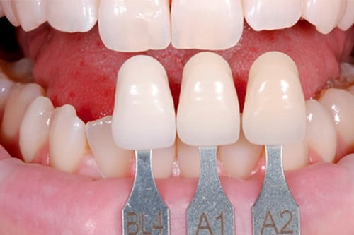 Bọc răng sứ để khắc phục răng thưa