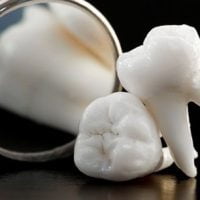 Nhổ răng khôn khi niềng răng Invisalign