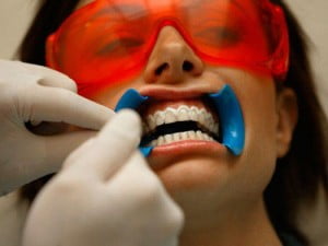 Phương pháp tẩy trắng răng tiết kiệm chi phí 