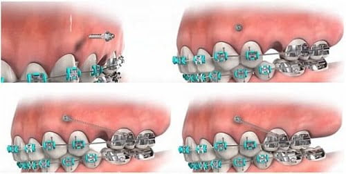 Trường hợp lệch lạc nhiều có thể sử dụng mini vít để đẩy nhanh quá trình niềng răng