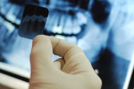 Niềng răng tác động đến cả xương hàm chứ không phải chỉ từng răng riêng lẽ