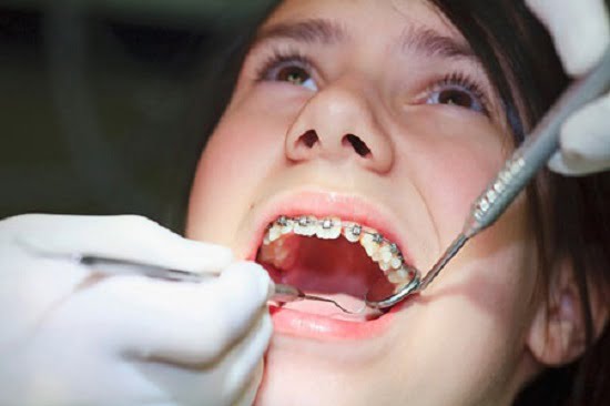 Các bước của quy trình niềng răng mắc cài