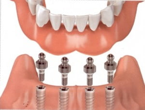 Điều cần biết khi chuẩn bị trồng răng implant