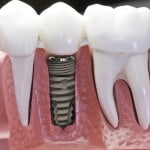 Hàm có răng cấy ghép implant có niềng răng được không?