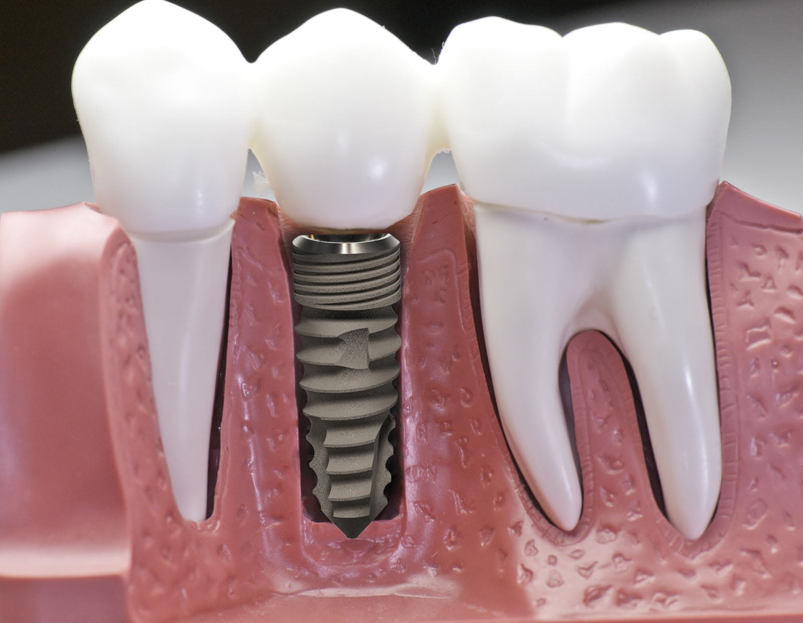 Răng cấy ghép implant và răng thường