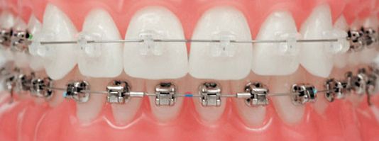 Niềng răng là sử dụng khí cụ nha khoa kéo răng về đúng vị trí