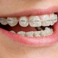 Lợi ích của niềng răng - Niềng răng nhanh