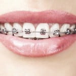 Niềng răng thẩm mỹ có chữa hết móm?