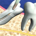 Có cần phải nhổ răng khi niềng răng?
