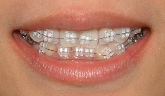 Niềng răng là giải pháp hiệu quả nhất cho răng khấp khểnh