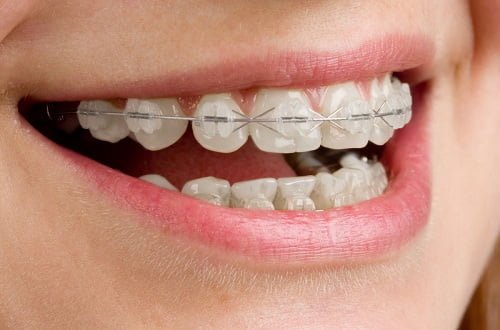 Chỉnh răng thưa bằng phương pháp nào là hiệu quả nhất? 3