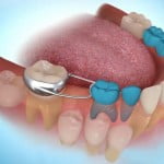Niềng răng điều trị răng nanh mọc ngầm trong xương hàm