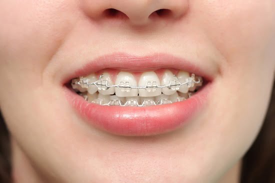 Tình trạng răng hô sẽ được cải thiện hiệu quả nhờ niềng răng