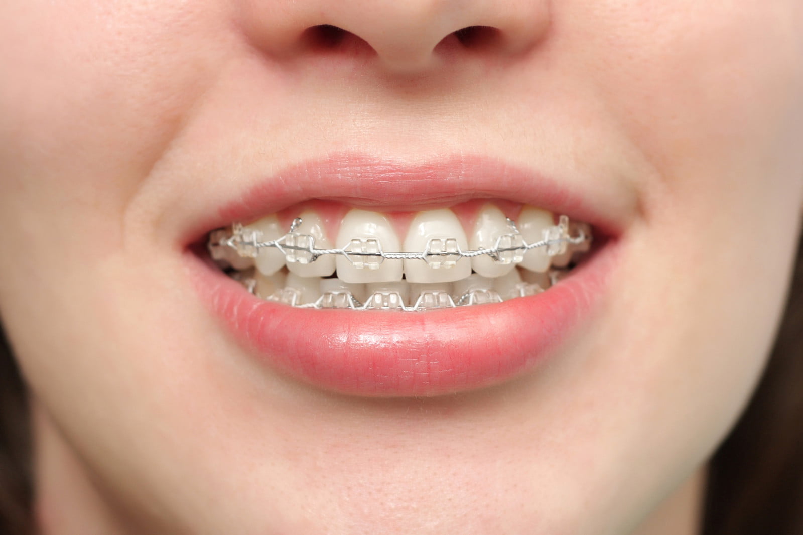 Lực mắc cài khá nhỏ so với kết cấu vững chắc của răng, xương hàm