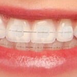 Điều trị hô bằng niềng răng mắc cài sứ