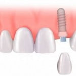 Trồng răng implant có đắt không?