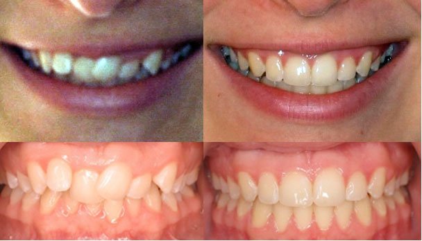 Niềng răng hô hàm trên hiệu quả và an toàn