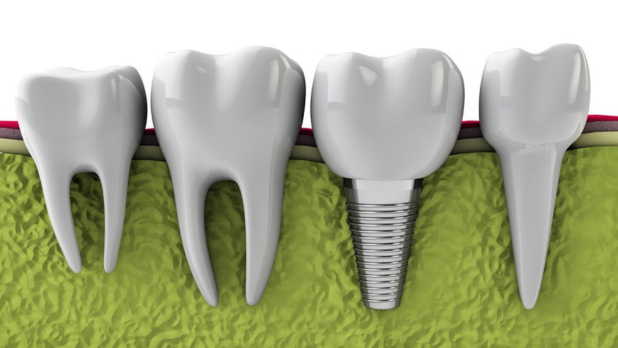 Cấy ghép implant phục hình răng đã mất hiệu quả