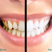 Tẩy trắng răng an toàn hiệu quả tại nha khoa