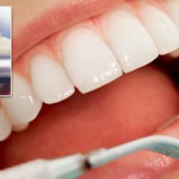 chảy máu chân răng là dấu hiệu của bệnh gì