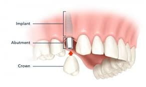 Cấu tạo của răng Implant