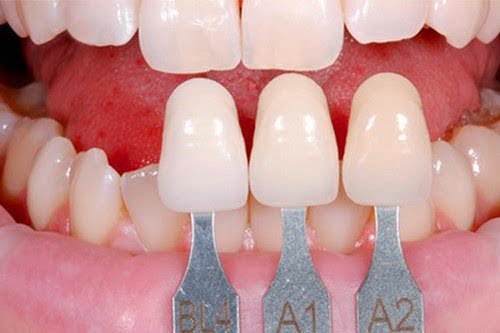Bọc răng sứ cho răng hô tiết kiệm thời gian điều trị hô 1