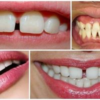 Bọc răng sứ cho răng thưa có những ưu điểm nào?