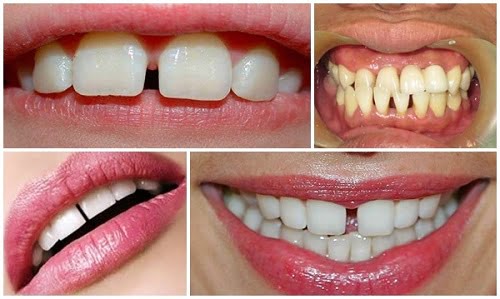 Bọc răng sứ cho răng thưa có những ưu điểm nào?