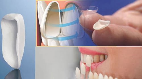 Bọc răng sứ veneer - Các đối tượng phù hợp nhất 3