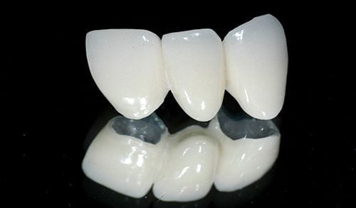 Các loại răng sứ được khách hàng yêu thích nhất 4