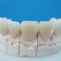 Răng sứ không kim loại - Thông tin bạn nhất định phải biết