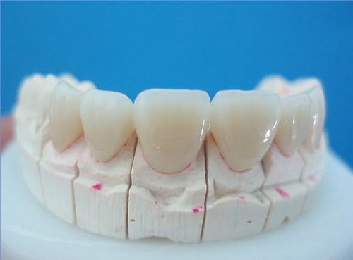 Răng sứ không kim loại - Thông tin bạn nhất định phải biết